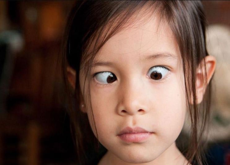 Lác mắt: Là tình trạng một mắt tập trung nhìn thẳng về phía trước, mắt còn lại di chuyển vào trong, ra ngoài, lên trên và xuống dưới. Để tránh bị song thị, não của trẻ có thể bỏ qua hình ảnh từ mắt không tập trung nhìn thẳng. Những điều này có thể làm cho thị giác không phát triển bình thường.